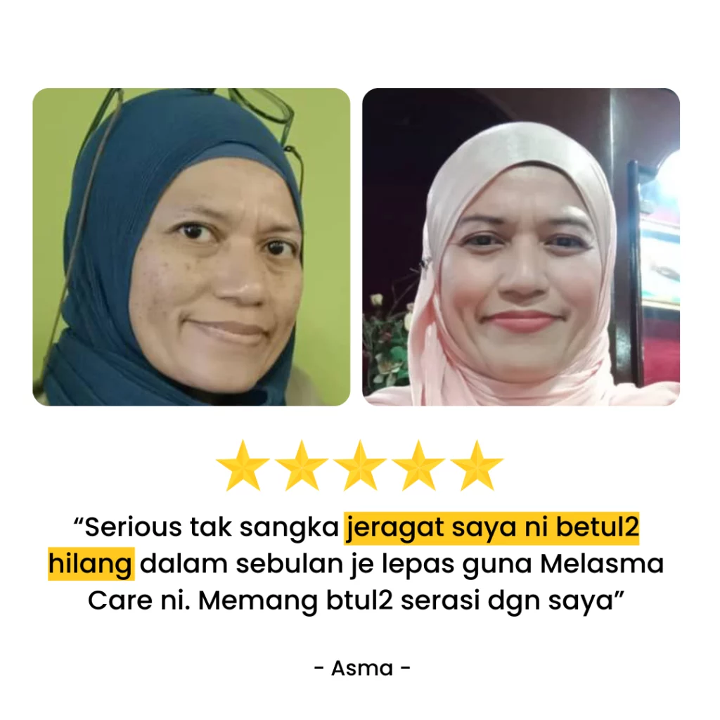 Melasma-Care-Testimoni