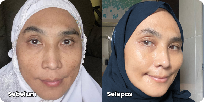 Testimoni-Melasma-Care