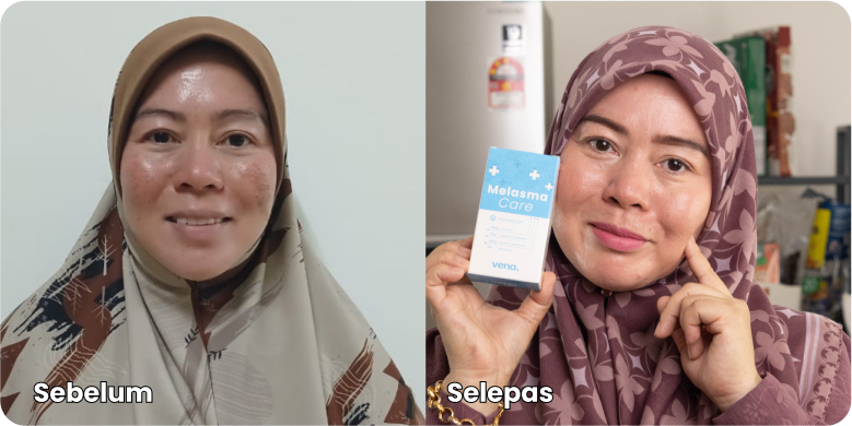 Testimoni-Melasma-Care