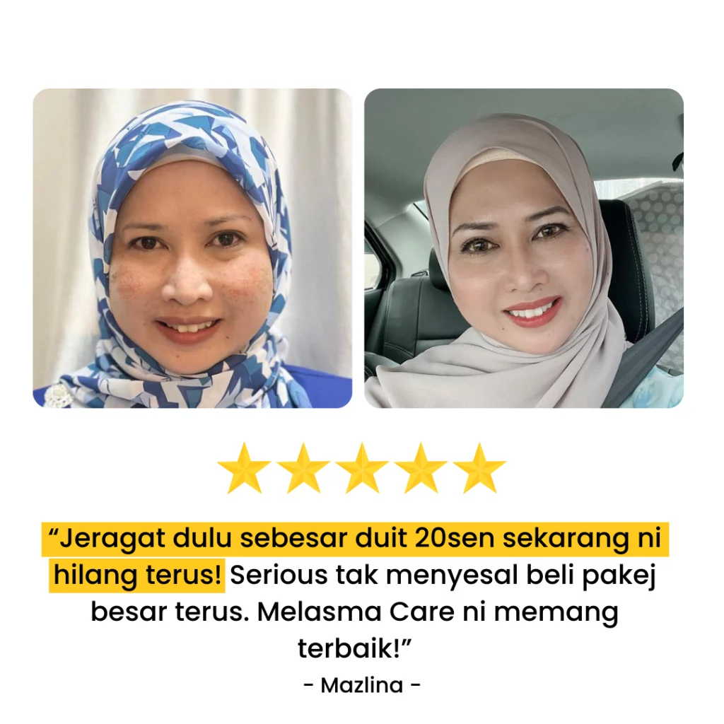 Melasma-Care-Testimoni